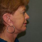 Facelift Before & After Patient #606