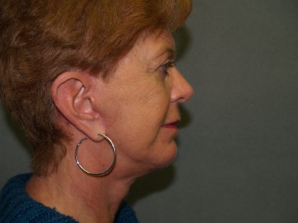 Facelift Before & After Patient #606