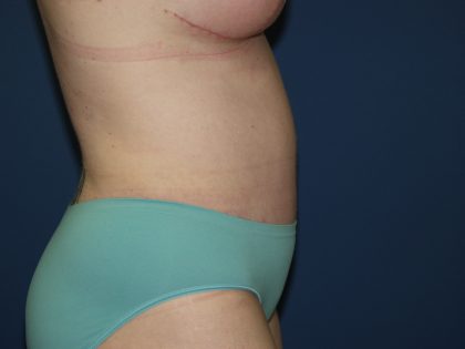 Tummy Tuck Before & After Patient #2102