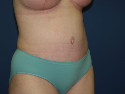 Tummy Tuck Before & After Patient #2102