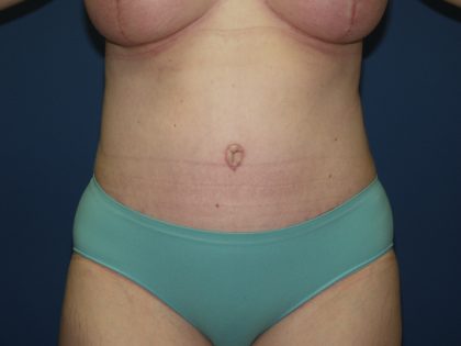 Tummy Tuck Before & After Patient #2102