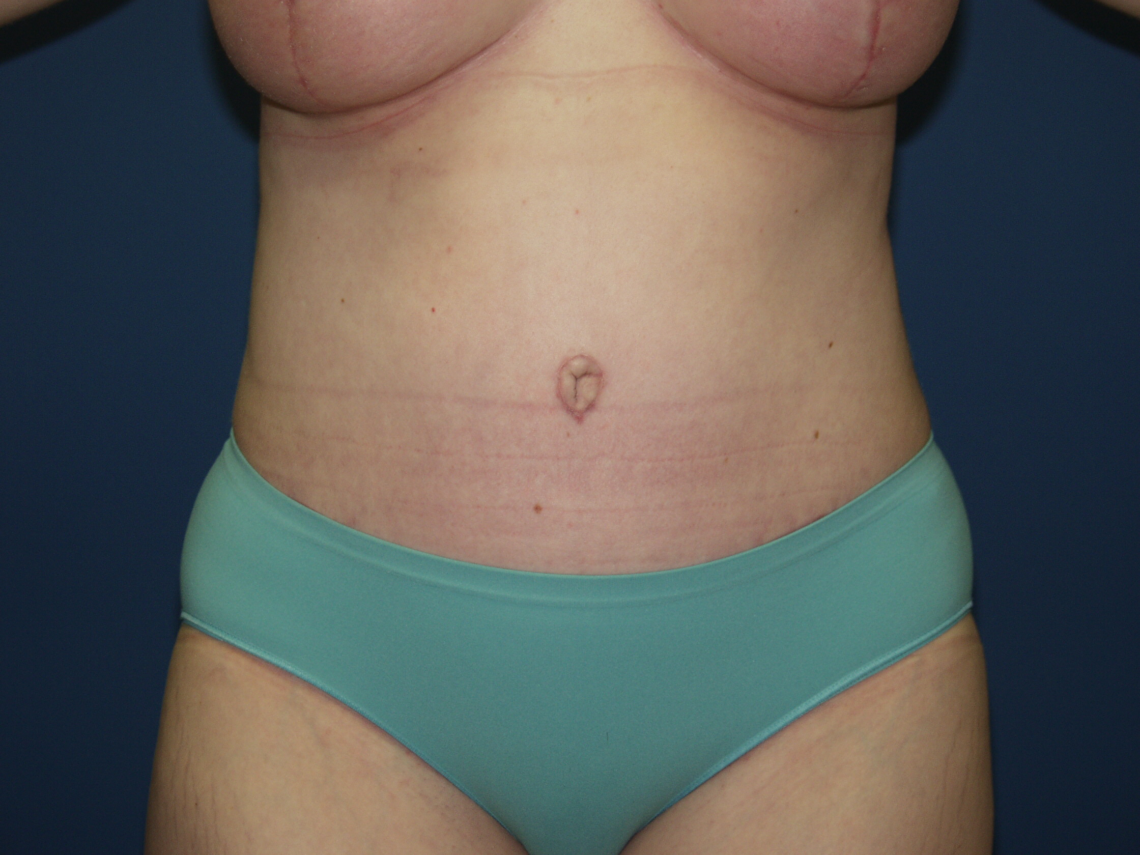 Tummy Tuck Before & After Patient #2102