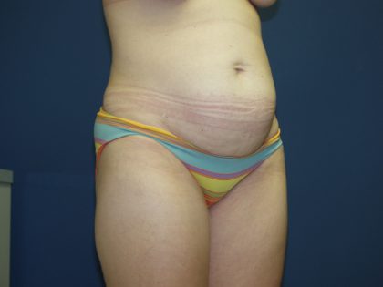 Tummy Tuck Before & After Patient #2102