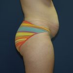 Tummy Tuck Before & After Patient #2102