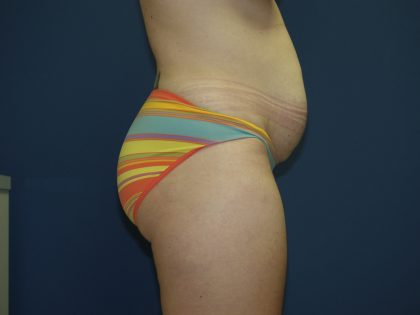 Tummy Tuck Before & After Patient #2102