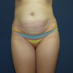 Tummy Tuck Before & After Patient #2102