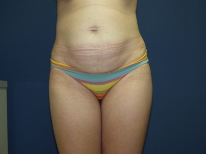 Tummy Tuck Before & After Patient #2102