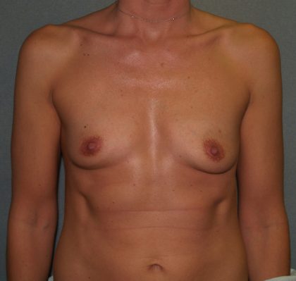 Breast Augmentation Before & After Patient #2440