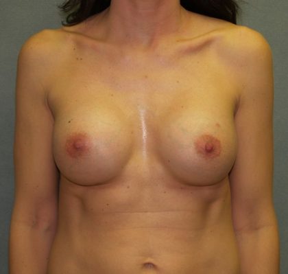 Breast Augmentation Before & After Patient #2440