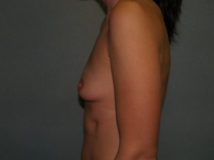 Breast Augmentation Before & After Patient #2440