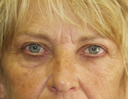 Eye Lid Lift Before & After Patient #679