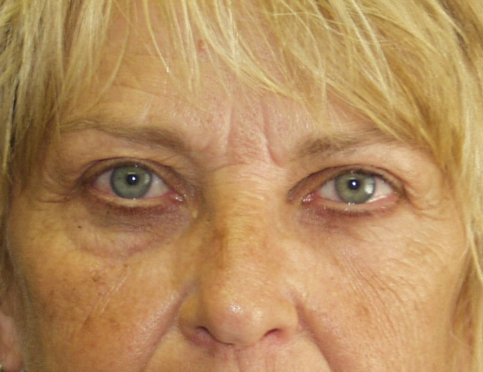 Eye Lid Lift Before & After Patient #679