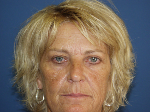 Facelift Before & After Patient #505