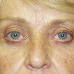 Eye Lid Lift Before & After Patient #679