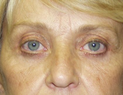 Eye Lid Lift Before & After Patient #679