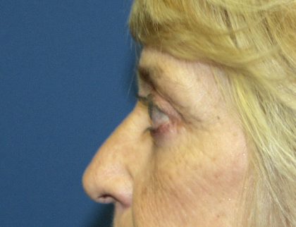 Eye Lid Lift Before & After Patient #679