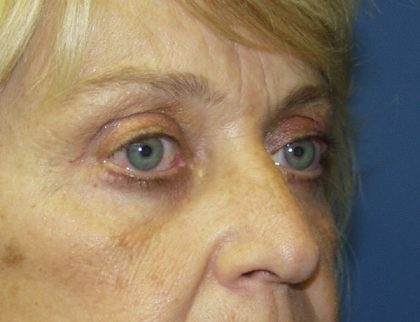 Eye Lid Lift Before & After Patient #679