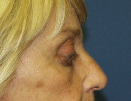 Eye Lid Lift Before & After Patient #679