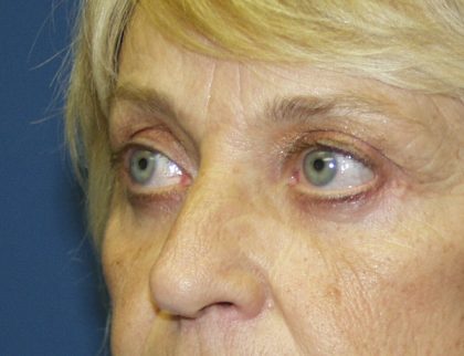 Eye Lid Lift Before & After Patient #679