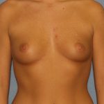 Breast Augmentation Before & After Patient #2703