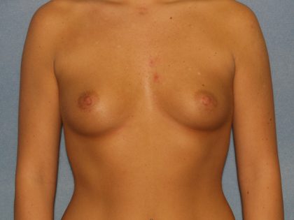 Breast Augmentation Before & After Patient #2703