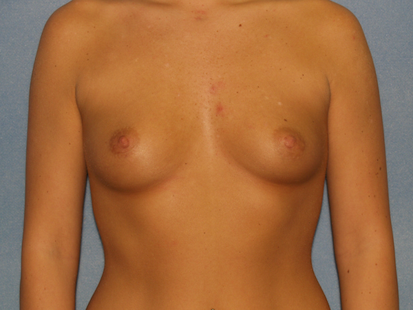 Breast Augmentation Before & After Patient #2703