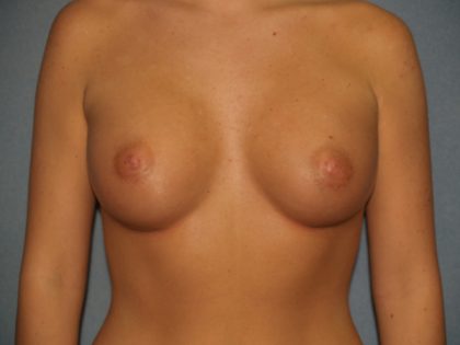 Breast Augmentation Before & After Patient #2703