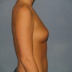 Breast Augmentation Before & After Patient #2703