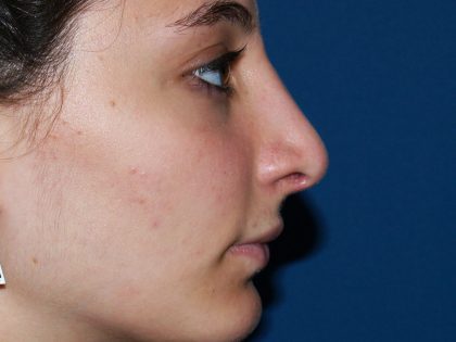 Nose Surgery Before & After Patient #826