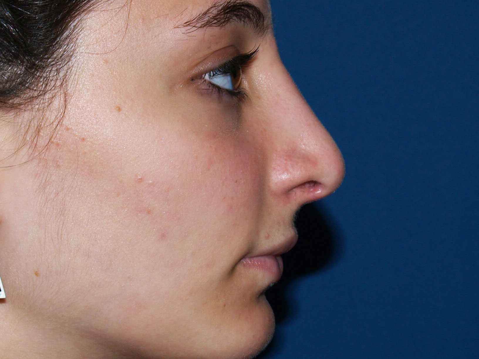 Nose Surgery Before & After Patient #826