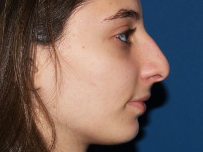 Nose Surgery Before & After Patient #826