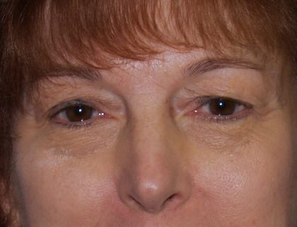 Eye Lid Lift Before & After Patient #688