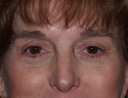 Eye Lid Lift Before & After Patient #688