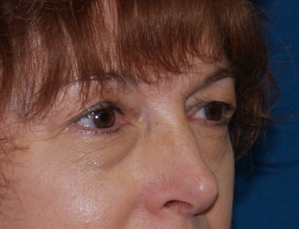 Eye Lid Lift Before & After Patient #688