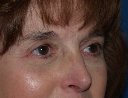 Eye Lid Lift Before & After Patient #688