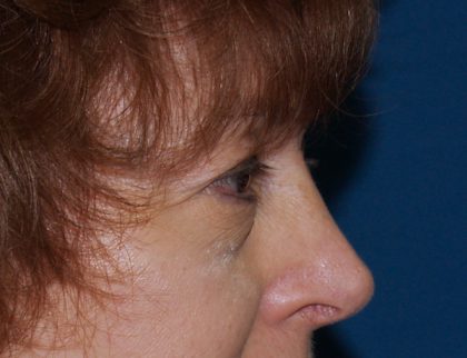 Eye Lid Lift Before & After Patient #688