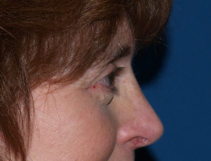 Eye Lid Lift Before & After Patient #688