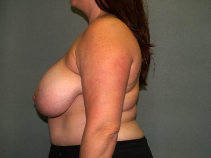 Breast Reconstruction Before & After Patient #1811