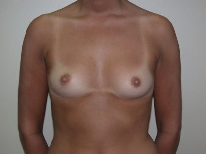 Breast Augmentation Before & After Patient #2976