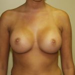 Breast Augmentation Before & After Patient #2976