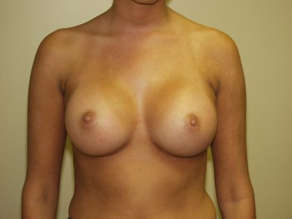 Breast Augmentation Before & After Patient #2976