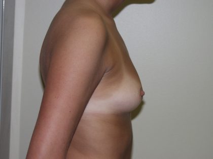 Breast Augmentation Before & After Patient #2976