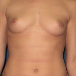 Breast Augmentation Before & After Patient #2997