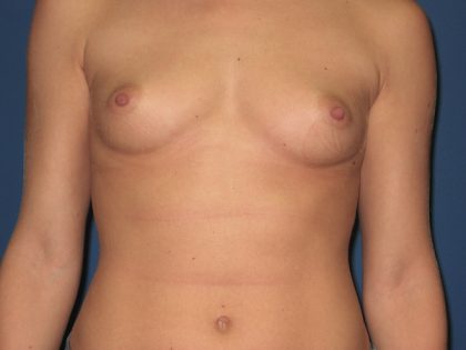 Breast Augmentation Before & After Patient #2997