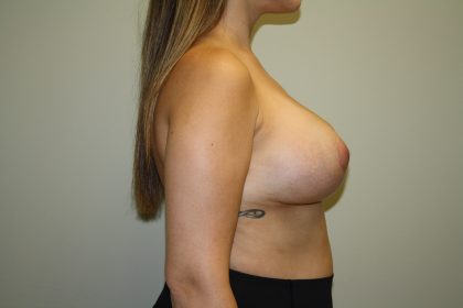 Breast Lift with Implant Before & After Patient #1587