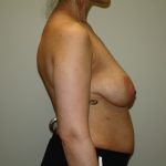 Breast Lift with Implant Before & After Patient #1587