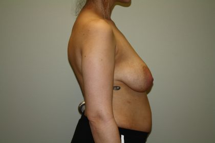 Breast Lift with Implant Before & After Patient #1587