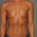 Breast Augmentation Before & After Patient #2864