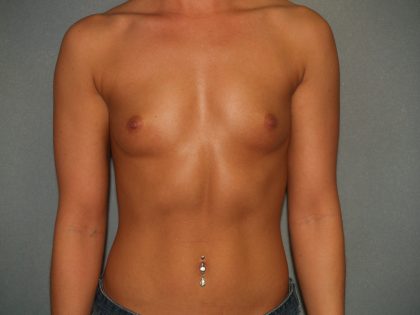 Breast Augmentation Before & After Patient #2864