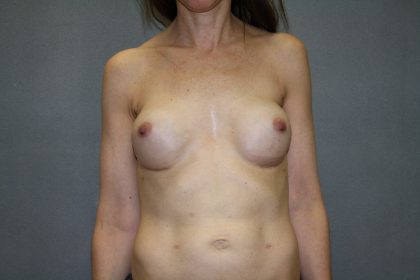 Breast Reconstruction Before & After Patient #2144